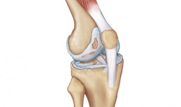 Cartilage Erosion of Knee Joint